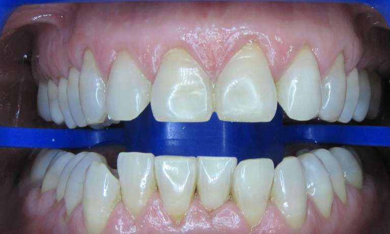 Zoom Teeth Whitening BMB Dental Before 1