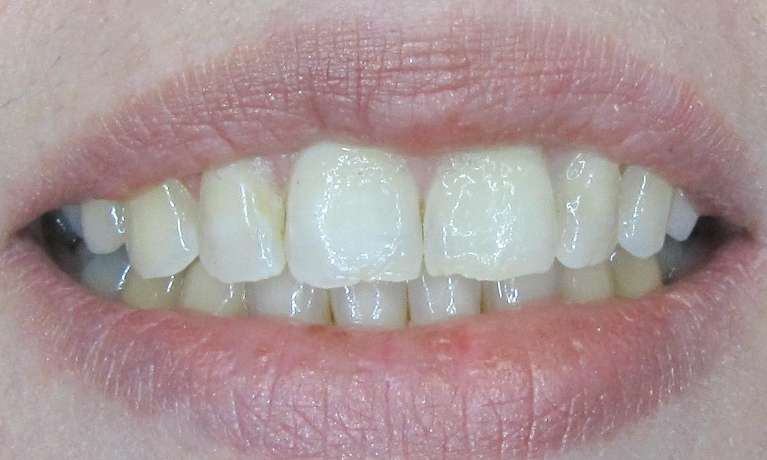 Zoom Teeth Whitening BMB Dental Before 2